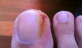 修甲沟炎的视频